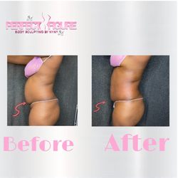 Perfect Figure Body Sculpting - This is client first session of Lipo Cavitation, laser lipo, and radio frequency!