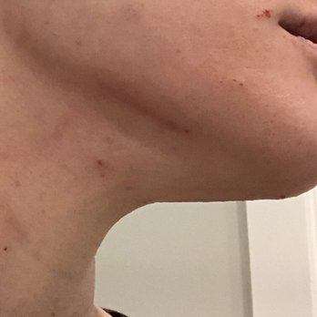 Nail Haus - Cut on my chin, neck, near my lip and a few other spots - Nail Salons Near Me - Bridgeville, Pennsylvania