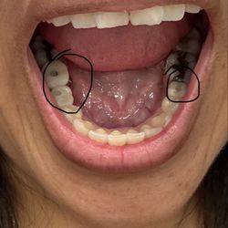 Smile Design Santa Clarita - I got a total of three implants 1 came out great and the other 2 horrible.