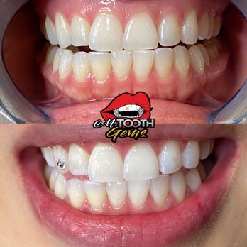M’s Tooth Gems - 60 min laser teeth whitening all natural plant based!! - Teeth Whitening Near Me - University Place, Washington M’s Tooth Gems - 60 min laser teeth whitening all natural plant based!! - Teeth Whitening Near Me - University Place, Washington