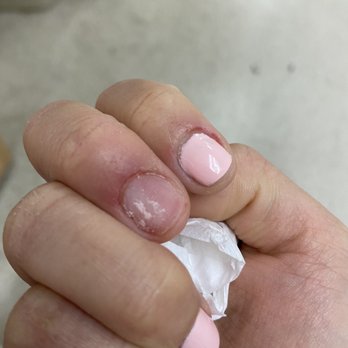 California Nails Design - day 2 - swollen fingers - Nail Salons Near Me - El Cajon, California