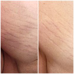 Bare Laser Center - Results for stretchmarks after two Microneedling treatments