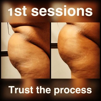 Body Snatched Northwest - Butt Lift - Body Contouring Near Me - Houston, Texas Body Snatched Northwest - Butt Lift - Body Contouring Near Me - Houston, Texas
