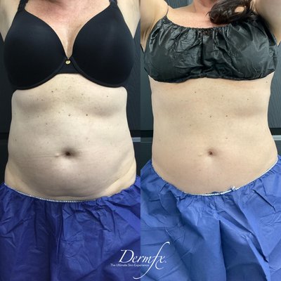 Body Contouring & Fat Loss - We offer a wide range of body contouring treatments including CoolSculpting Elite, Emsculpt NEO, Venus Legacy, Tempsure, VZet, Morpheus8 for body. Our body contouring specialists are highly trained from CoolSculpting University.