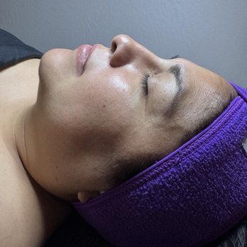 Pura Vida Bella - Before and after photos - Skin Care Near Me - Sacramento, California Pura Vida Bella - Before and after photos - Skin Care Near Me - Sacramento, California