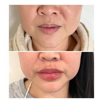 Skin Fit LA - Lip filler - Skin Care Near Me Skin Fit LA - Lip filler - Skin Care Near Me