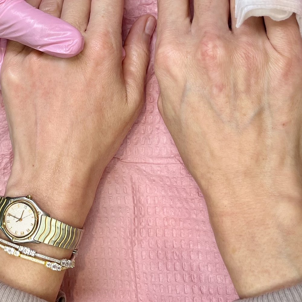 Virginia Eye Consultants - Hand fillers - after one treatment. I will upload recent photos after my last treatment. - Optometrists Near Me - Norfolk, Virginia