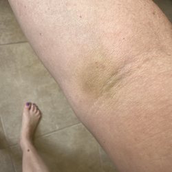 Quest Diagnostics - Day 6 after blood draw.