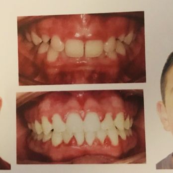 Lisa King, DDS, MS - Before and After results. - Orthodontists Near Me - Albuquerque, New Mexico Lisa King, DDS, MS - Before and After results. - Orthodontists Near Me - Albuquerque, New Mexico