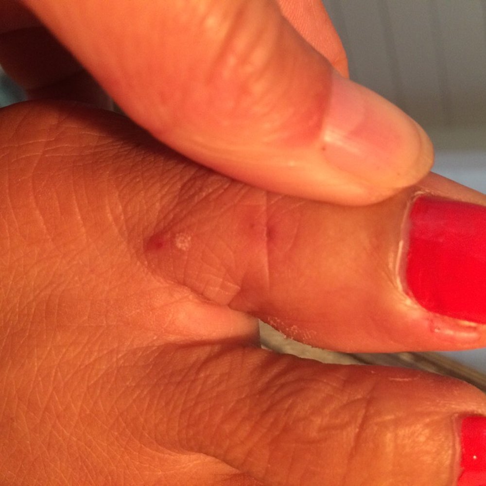Holly Nails - One week later-- still scraped and fungus! - Nail Salons Near Me - Mill Valley, California Holly Nails - One week later-- still scraped and fungus! - Nail Salons Near Me - Mill Valley, California