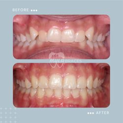 My LA Braces - From start to finish, a healthier and more confident smile!