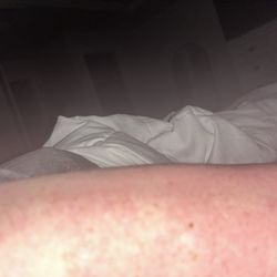Another view of my arm 14 hours after BBL laser however my other arm didn't look anything like this.