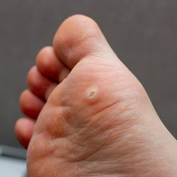 All South Bay Footcare - Plantars Warts on Foot
