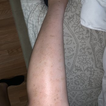SEV Laser - It was so bad! - Laser Hair Removal Near Me - San Francisco, California SEV Laser - It was so bad! - Laser Hair Removal Near Me - San Francisco, California