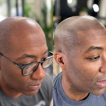 The Micro Clinics - Scalp Micropigmentation - Permanent Makeup Near Me - Orlando, Florida The Micro Clinics - Scalp Micropigmentation - Permanent Makeup Near Me - Orlando, Florida
