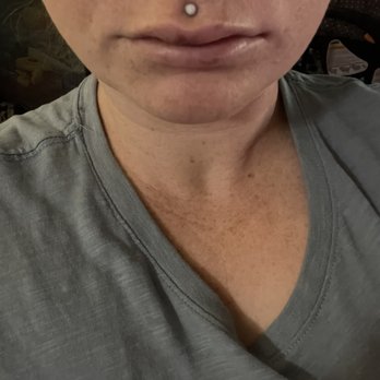 Napa Solano Plastic Surgery - 90% of the lip filler was injected in the middle of my upper lip leaving the rest unproportunate - Plastic Surgeons Near Me - Napa, California Napa Solano Plastic Surgery - 90% of the lip filler was injected in the middle of my upper lip leaving the rest unproportunate - Plastic Surgeons Near Me - Napa, California