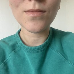 New lips a day after procedure
