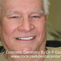 Rock Creek Dental Center - All natural teeth with crowns, patient of over 14 years.