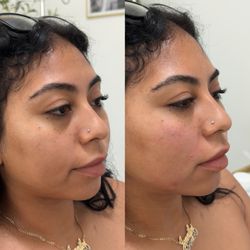 Glamour By Gaby - EZ Gel PRF Undereyes & smile lines before and after