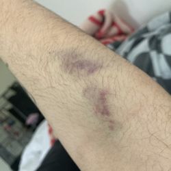 AllCare Primary & Immediate Care - Bruised arm from the technician failing to do a blood draw