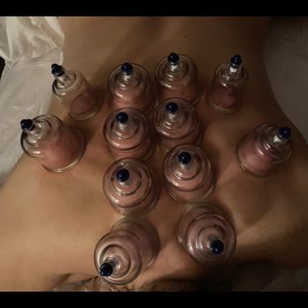 A's Body Works - Cupping - Massage Near Me - New York, New York A's Body Works - Cupping - Massage Near Me - New York, New York