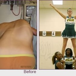 Spine Associates Beaumont - Adolescent Idiopathic Scoliosis Correction Before & After