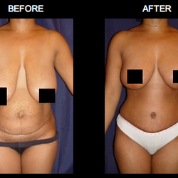 Lexington Plastic Surgeons - Tummy tuck and a breast lift and implants