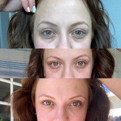 New Elite Aesthetics - Bellafill and a little Botox Before Right After Injections Day After