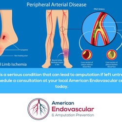 Premier Endovascular