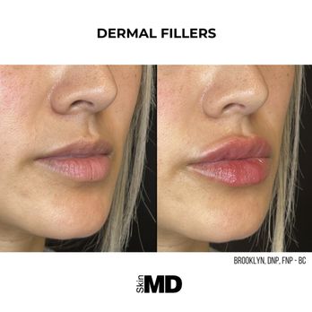SkinMD - Enhance what you have at Skin MD with lip filler! - Skin Care Near Me - Hyannis, Massachusetts SkinMD - Enhance what you have at Skin MD with lip filler! - Skin Care Near Me - Hyannis, Massachusetts