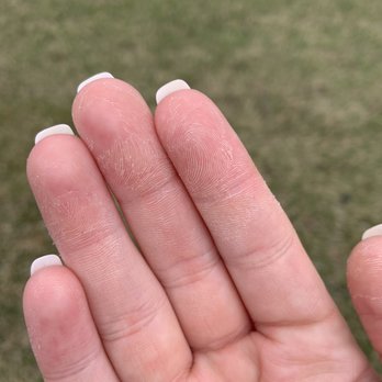 M Nails Boutique - Peeling from too much acetone - Nail Salons Near Me - Schaumburg, Illinois