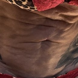 Abdomen post surgery Abdomen post surgery