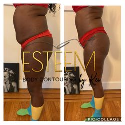 Esteem Body Contour by Kei - Non invasive Lipo 360