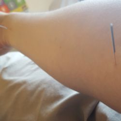 Orem Community Acupuncture - Treatment points with needles.