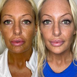 Suddenly Slimmer Med Spa - 1st photo is immediately after Voluma to cheeks, jowls; Botox; Juvederm Lips top & bottom. 2nd photo is 4 weeks post op.