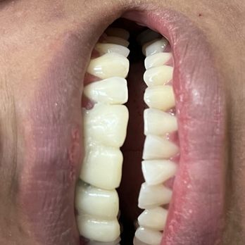 Harbor Dental Group: Alexander Vilderman - Zoom bleaching - General Dentistry Near Me - West Sacramento, California Harbor Dental Group: Alexander Vilderman - Zoom bleaching - General Dentistry Near Me - West Sacramento, California