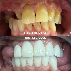 Lavo Dental - Northridge Dentist Lavo Dental Before & After photo