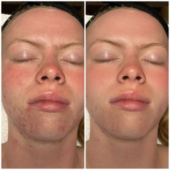 Cool Indulge Wellness  - acne facial before and after - Cryotherapy Near Me - Fullerton, California
