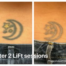 Emily Bonney - Tattoo removal