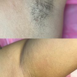 A gorg before and after of a quick underarm wax!
#prettypits