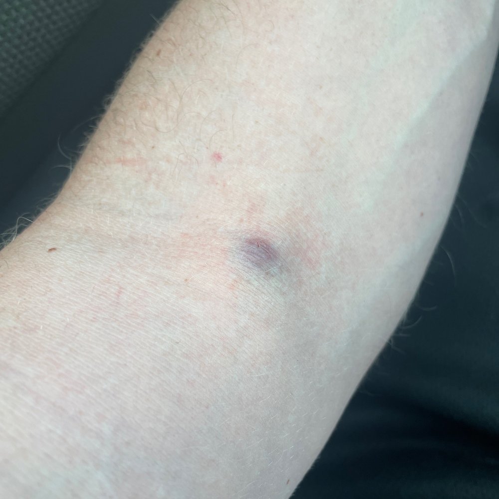 Labcorp - Bruised / raised injection site - Laboratory Testing Near Me - Rockville, Maryland Labcorp - Bruised / raised injection site - Laboratory Testing Near Me - Rockville, Maryland