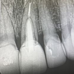 Patrick Yoshikane, DDS - My fractured front tooth