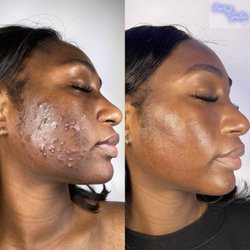 Face of Jules - Before and afters (only 2 treatments)
