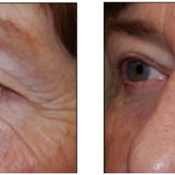 Edward Lee, MD - upper and lower eyelid blepharoplasty - Ophthalmologists Near Me - Los Angeles, California Edward Lee, MD - upper and lower eyelid blepharoplasty - Ophthalmologists Near Me - Los Angeles, California