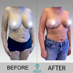 Liposuction Center Moein Surgical Arts - Breast Implant Removal with Fat grafting
