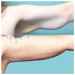 Restore Plastic Surgery - Bilateral Brachioplasty or Arm Lift After Weight Loss
