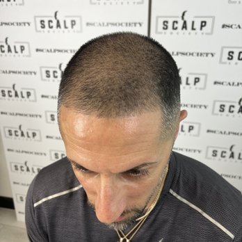 Scalp Society - Before pic taken at Scalp Society - Hair Loss Centers Near Me - San Jose, California