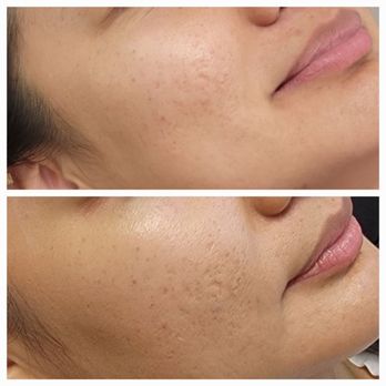 Defined Visage - Procell Microchanneling to help treat acne scarring - Eyebrow Services Near Me - Long Beach, California
