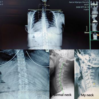 Dean Wang, MD - Spinal compression, caused by whiplash. I felt seering pain as my spine curved. Standing straight, my vertebrae touch the base of skull - Sports Medicine Near Me - Orange, California Dean Wang, MD - Spinal compression, caused by whiplash. I felt seering pain as my spine curved. Standing straight, my vertebrae touch the base of skull - Sports Medicine Near Me - Orange, California