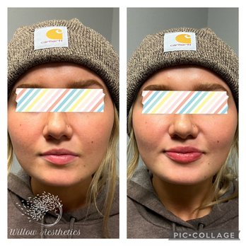 Willow Aesthetics - Before and after lip filler - Medical Spas Near Me - Newberg, Oregon Willow Aesthetics - Before and after lip filler - Medical Spas Near Me - Newberg, Oregon